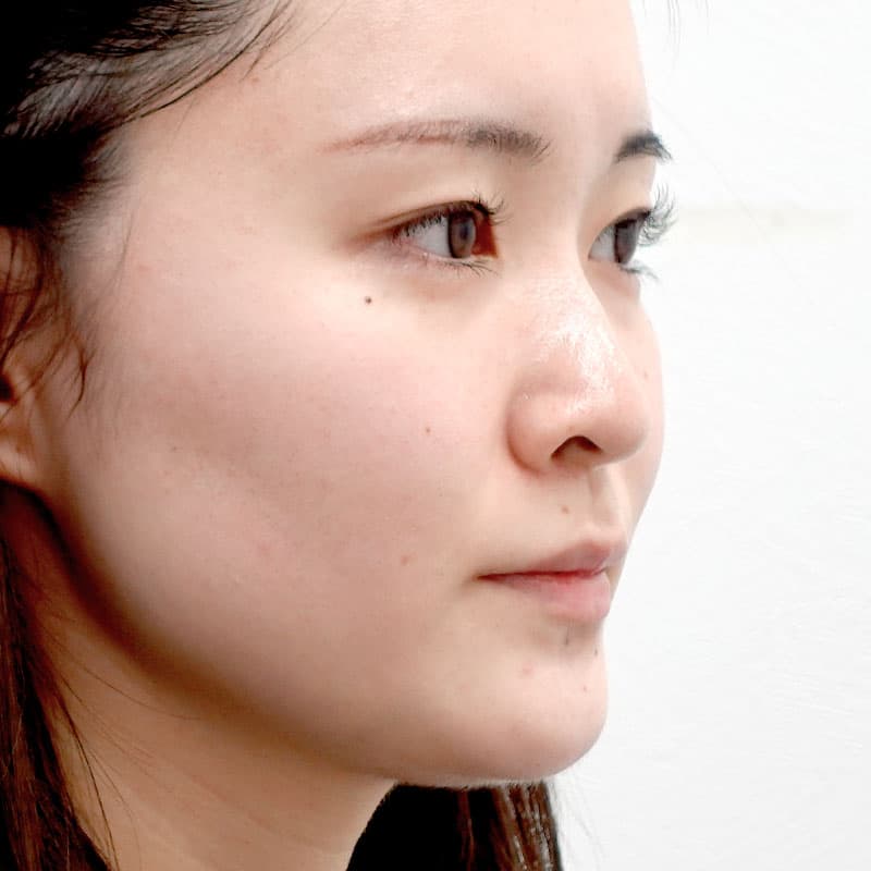 20250831_St20250831_tanaka_hyaluronic lips eye bags nose　①Before